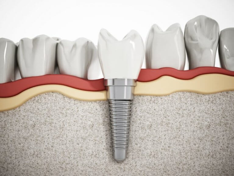 Dental Implant Treatment Cost