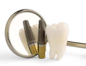 A. Scott Grivas III, DDS, INC. | Immediate vs. Delayed Dental Implants A. Scott Grivas III, DDS, INC. | Immediate vs. Delayed Dental Implants
