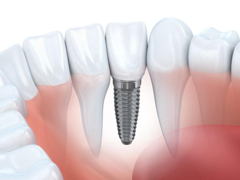 Dental Implant Service Cost