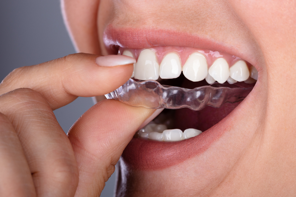 Invisalign Dentist Service