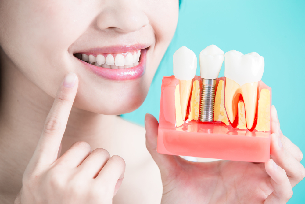 Dental Implant Cost