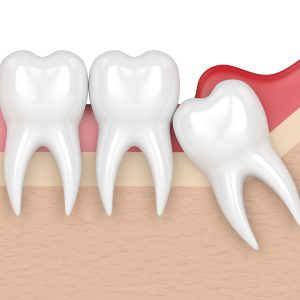 wisdom teeth