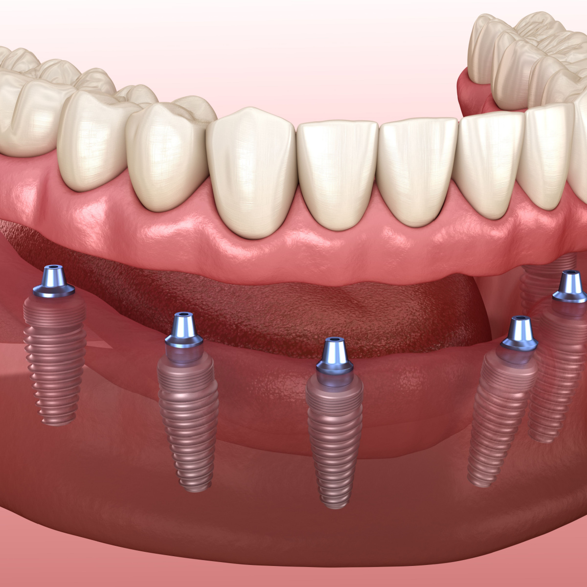 Price for Full Dental Implants