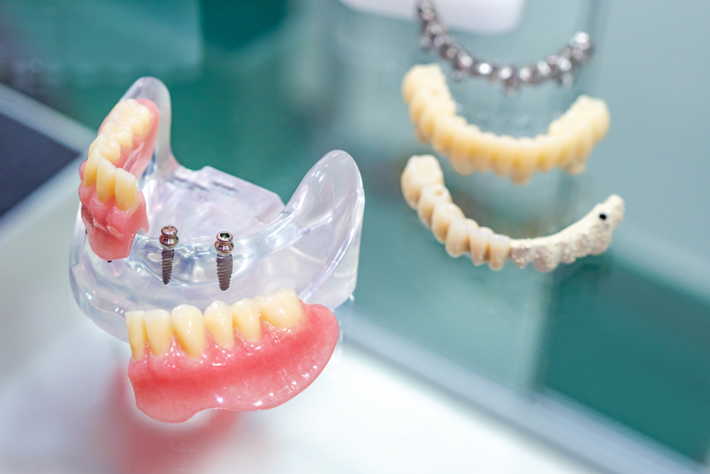 Affordable Dental Implants Service