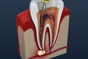 A. Scott Grivas III, DDS, INC. | Dealing with Tooth Abscesses: Symptoms, Treatment, and Prevention A. Scott Grivas III, DDS, INC. | Dealing with Tooth Abscesses: Symptoms, Treatment, and Prevention
