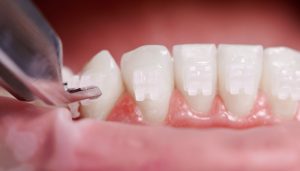 A. Scott Grivas III, DDS, INC. | The Power of Strategic Attachment Placement A. Scott Grivas III, DDS, INC. | The Power of Strategic Attachment Placement