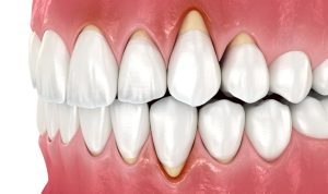 A. Scott Grivas III, DDS, INC. | Can You Brush Too Much? The Risks of Overbrushing A. Scott Grivas III, DDS, INC. | Can You Brush Too Much? The Risks of Overbrushing